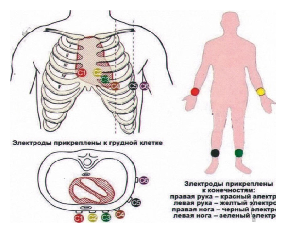 Места наложения электродов при проведении процедуры ЭКГ