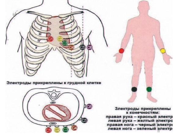   Процедура подготовки, выполнение электокардиографии (Острый коронарный синдром)