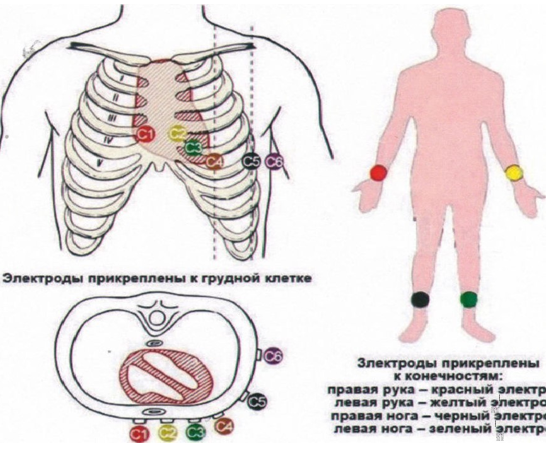 Процедура подготовки, выполнение электокардиографии (Фибрилляция и трепетание предсердий у взрослых)