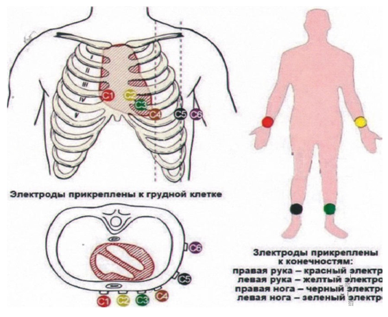 Процедура подготовки, выполнение электокардиографии ХСН